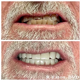 Before and after smile at Singing River Dentistry