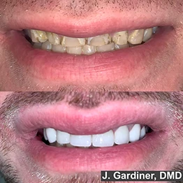 Before and after smile at Singing River Dentistry