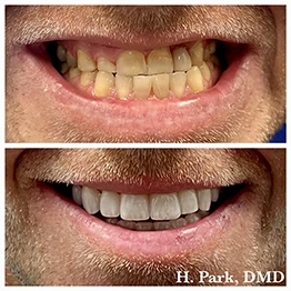 Before and after smile at Singing River Dentistry