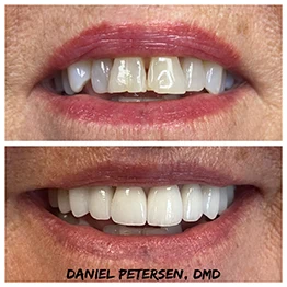 Before and after smile at Singing River Dentistry