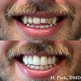 Before and after smile at Singing River Dentistry