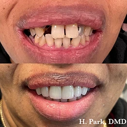 Before and after smile at Singing River Dentistry