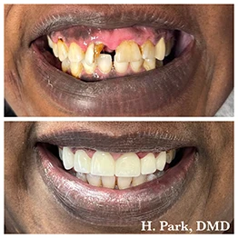 Before and after smile at Singing River Dentistry