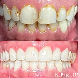 Before and after smile at Singing River Dentistry