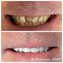 Before and after smile at Singing River Dentistry