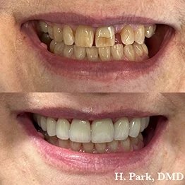 Before and after smile at Singing River Dentistry