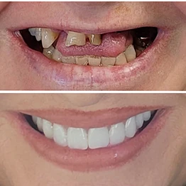 Before and after smile at Singing River Dentistry