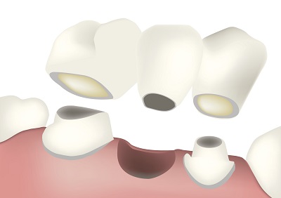 Issues Dental Bridges Can Fix