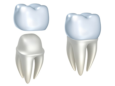 Image of a dental crown at Singing River Dentistry.