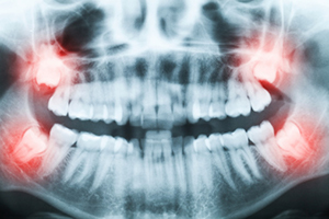 Wisdom teeth xray