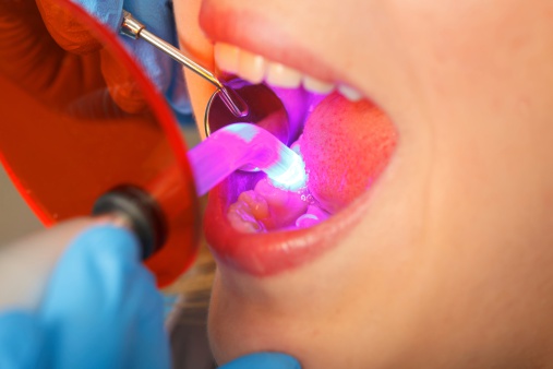 Is Bonding the Only Improvement Option You Have for Your Teeth?