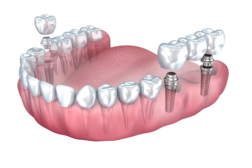 digital rendering of a mouth showing a single dental implant on the lower right jaw and an implant supported dental bridge on the lower left jaw at <a  class='TParticle'  href='/p/dentist-Florence-AL-Home-p64903.asp'  title='Home Singing River Dentistry Florence, AL dentist Florence AL'  >Singing River Dentistry</a> in Florence, AL