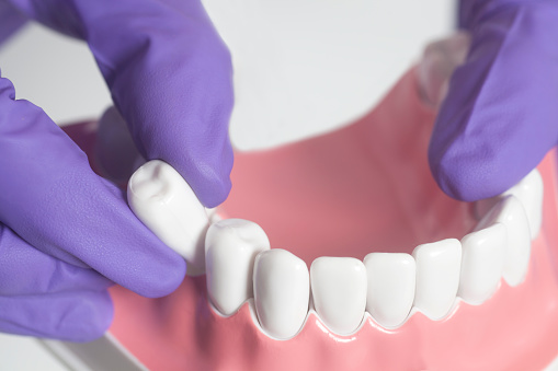 Everything you need to Know about Tooth Extraction