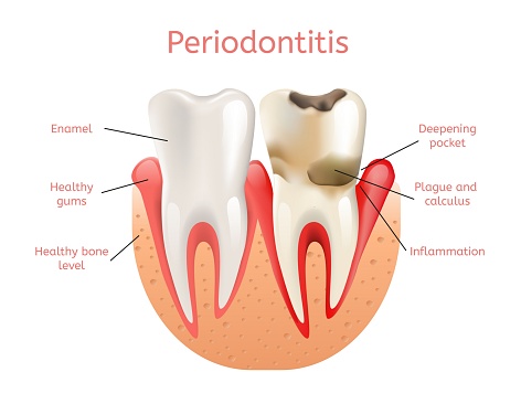 Image of a healthy tooth versus a tooth with gum disease at Singing River Dentistry.