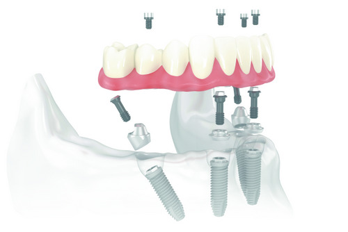 Diagram of All-on-4 Treatment Concept at Singing River Dentistry in Florence, AL 