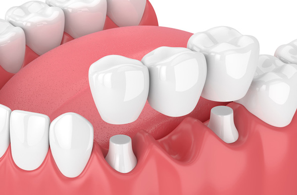 Rendering of jaw with dental bridge at Singing River Dentistry in Muscle Shoals, AL Rendering of jaw with dental bridge at Singing River Dentistry in Muscle Shoals, AL