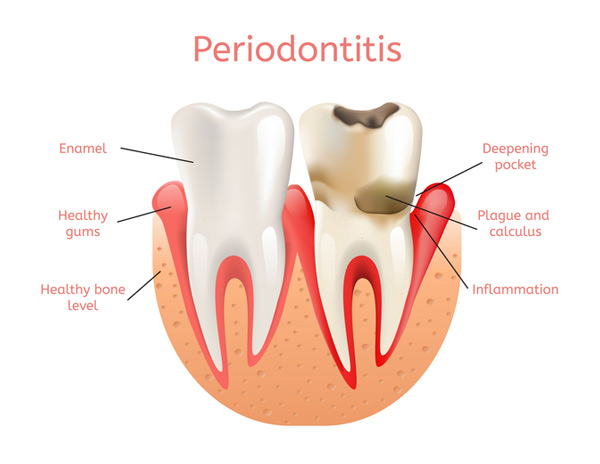 Diagram of a healthy tooth versus a tooth with periodontitisSinging River Dentistry in Muscle Shoals, AL 35661 Diagram of a healthy tooth versus a tooth with periodontitisSinging River Dentistry in Muscle Shoals, AL 35661