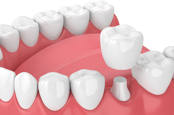 Rendering of jaw with dental crown.