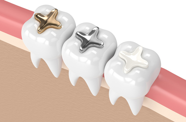 Rendering of teeth with 3 filling materials from Singing River Dentistry in Florence, AL