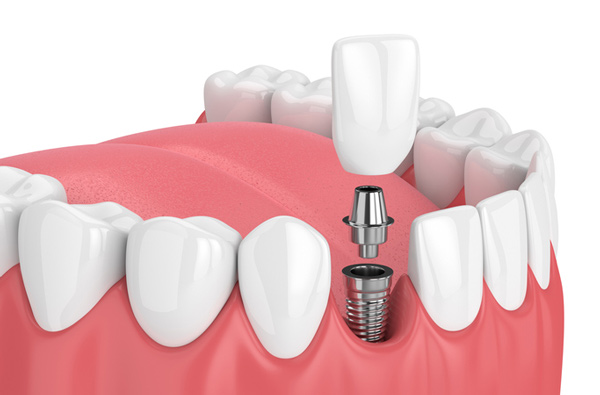 Rendering of a jaw with a dental implant at Singing River Dentistry in Florence, AL 