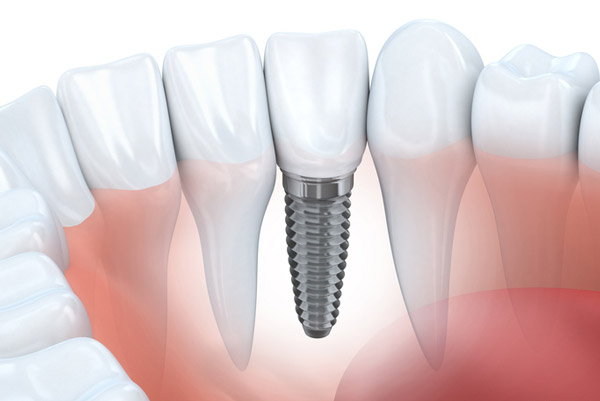 Diagram of dental implant in lower jaw provided by Singing River Dentistry in Muscle Shoals AL 35661  Diagram of dental implant in lower jaw provided by Singing River Dentistry in Muscle Shoals AL 35661