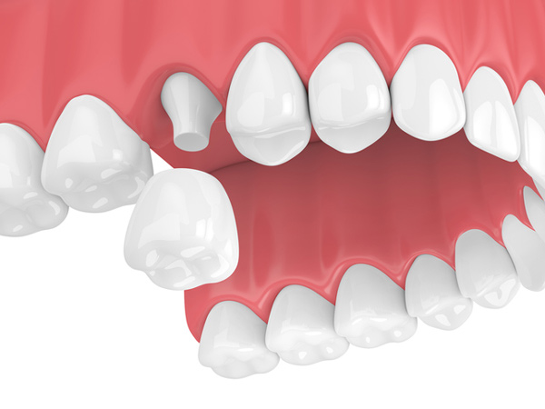 Rendering of jaw with dental crown at Singing River Dentistry.