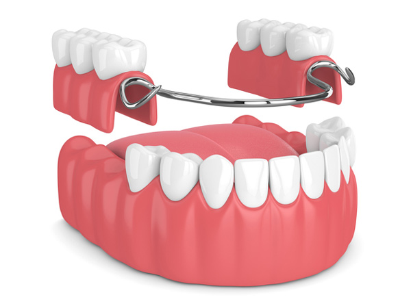 Rendering of removable partial denture at Singing River Dentistry in Florence, AL