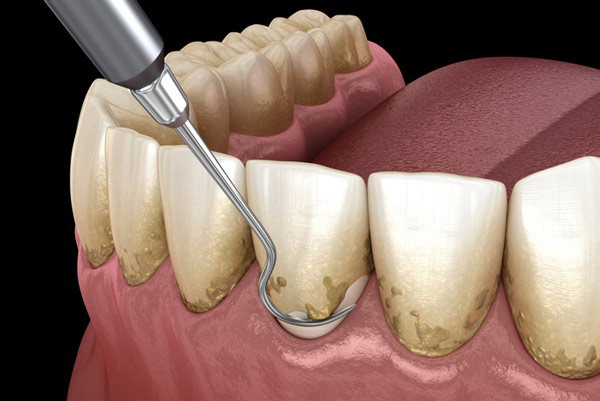 digital rendering of a scaling tool removing residue from a tooth at Singing River Dentistry in Florence, AL