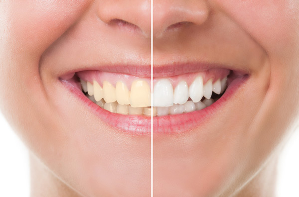 Before and after photo of teeth whitening treatment at at Singing River Dentistry in Florence, AL 