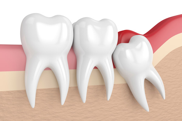 Illustration of an impacted wisdom tooth at Singing River Dentistry in Florence, AL 35630-1747