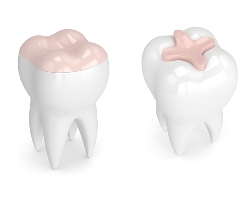 3D rendering of inlays and onlays offered at Singing River Dentistry in Florence, AL 35630-1747