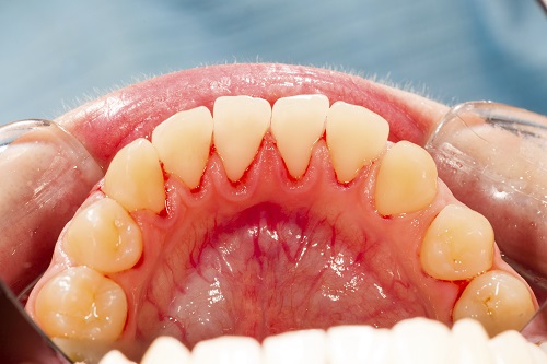 Can You Treat Gum Disease At Home?