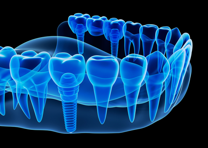 A rendering of a jaw with dental implants at Singing River Dentistry in Florence, AL