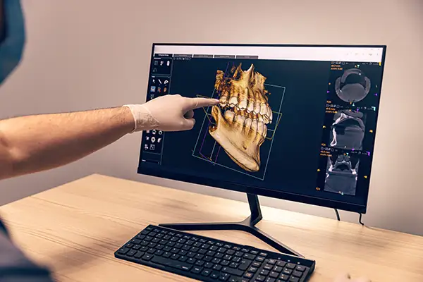 Dentist pointing at a 3D dental scan on a computer screen, analyzing details for a full mouth restoration procedure.
